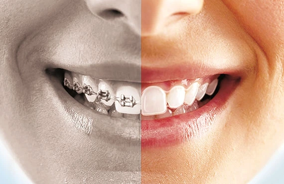 Image showing the difference between braces and SnapCorrect's clear aligners.